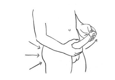 La crema del herpes sobre el miembro